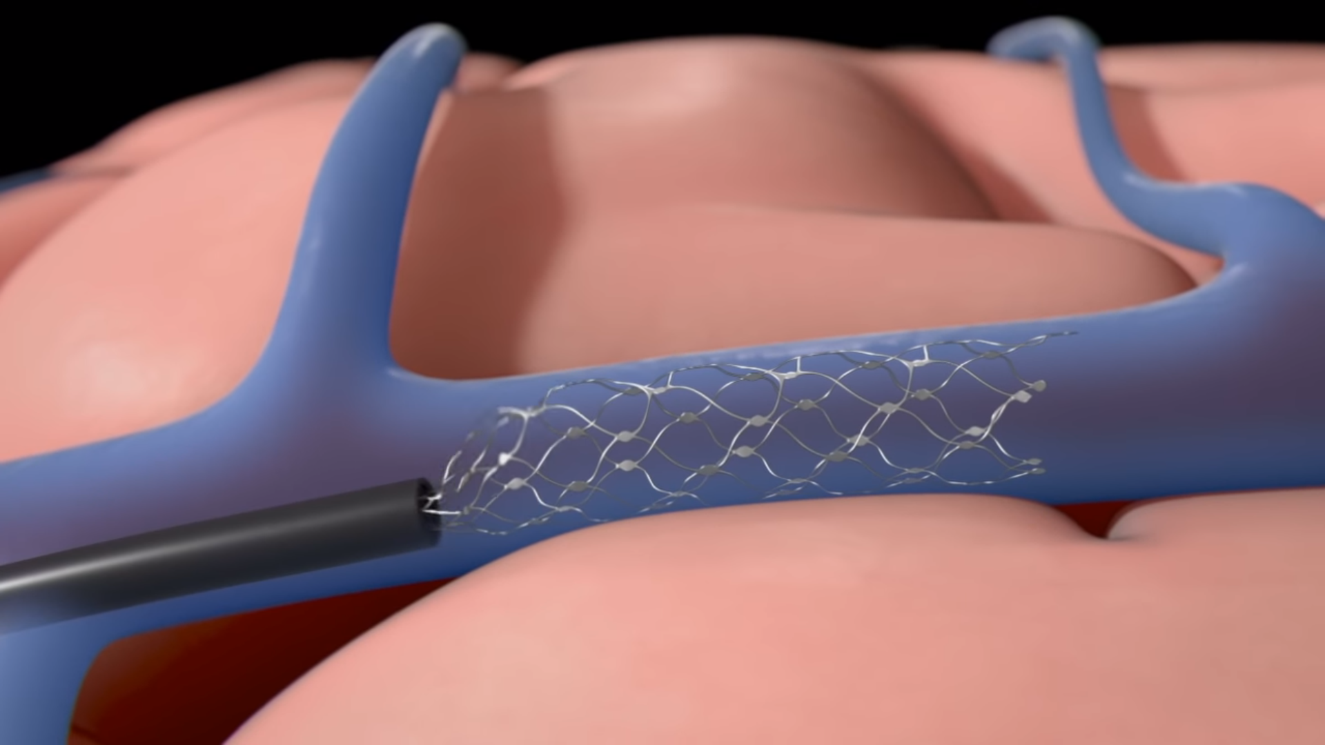     Nowy implant nerwowy połączy się z mózgiem poprzez żyłę szyjną