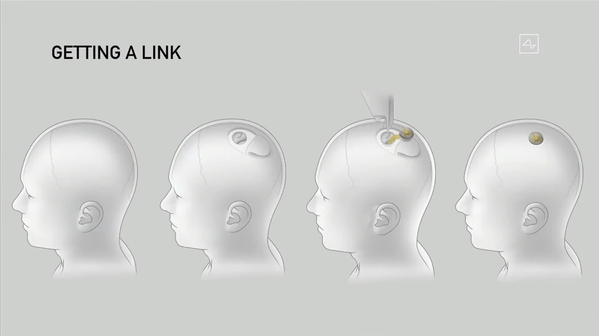 Neuralink V2 - kolejny krok w stronę cyberpunka